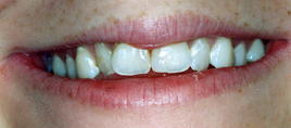 Before and After Gallery Cedar Park Premier Dentistry