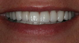 Before and After Gallery Cedar Park Premier Dentistry