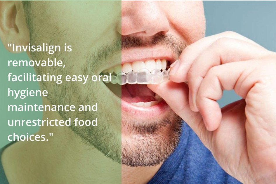 Navigating with Invisalign ensures straight teeth while allowing for easy hygiene and a variety of food choices.